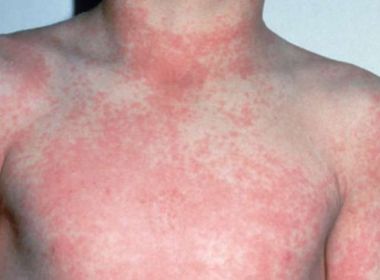 Novo tipo do vírus da Zika circula no Brasil; Fiocruz-BA prevê possibilidade de epidemia Foto: Divulgação