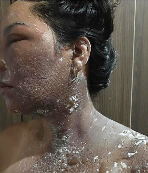 Vereadora fica com queimaduras graves após marido jogar água quente contra ela - Foto: Reprodução