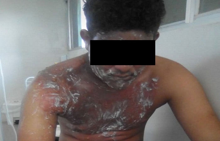Mulher joga água quente em namorado da filha por não aceitar relação