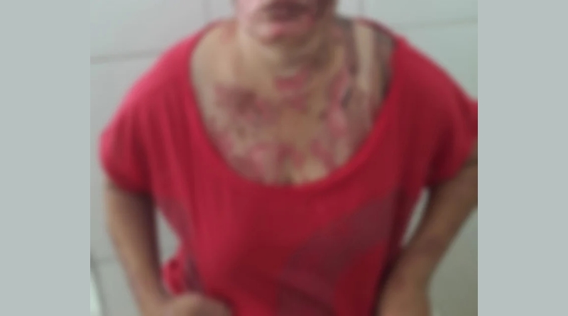Acusado de jogar gasolina e atear fogo na esposa é condenado a 9 anos no PI
